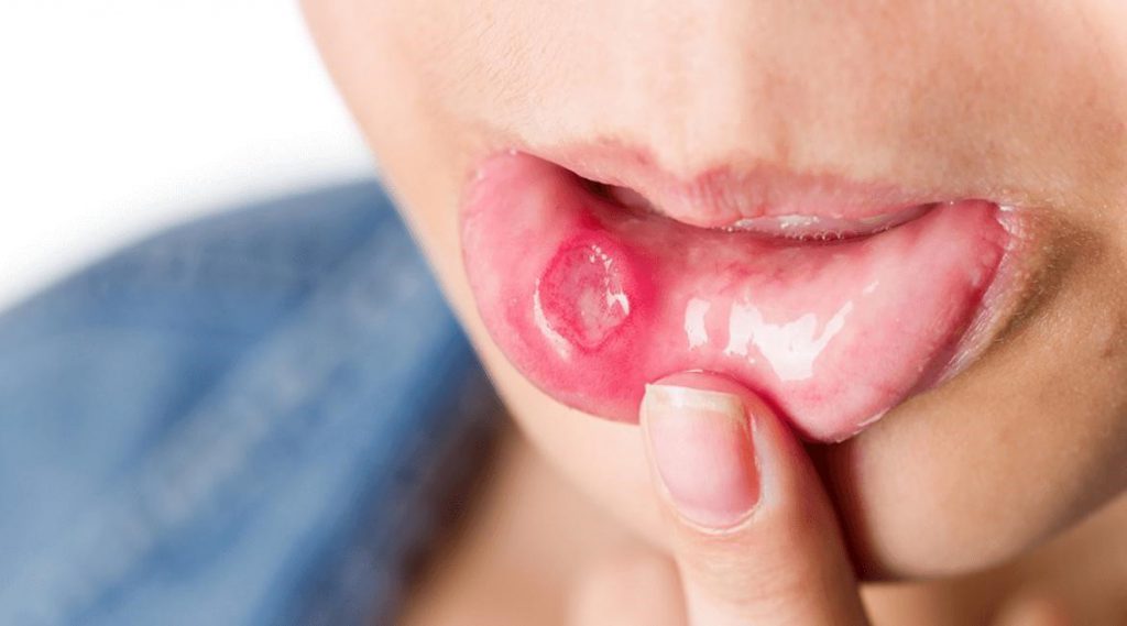Mouth Ulcers Not Letting You Enjoy Your Food? Learn How To Get Rid Of It