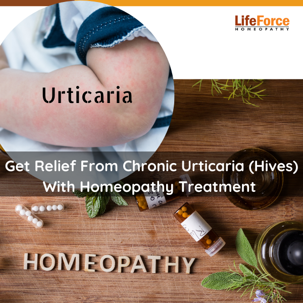 Get Relief From Chronic Urticaria Hives With Homeopathy Treatment