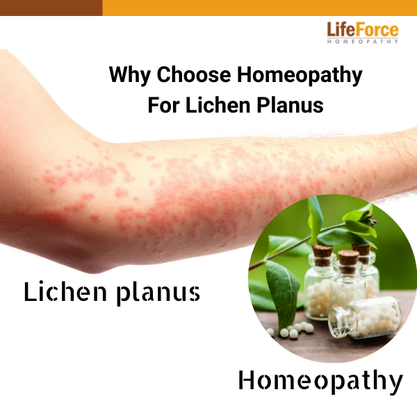 Why Choose Homeopathy For Lichen Planus