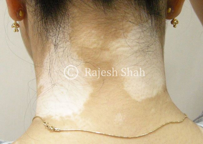 Vitiligo: Causes, Treatment, And Role Of Homeopathy In Treating It