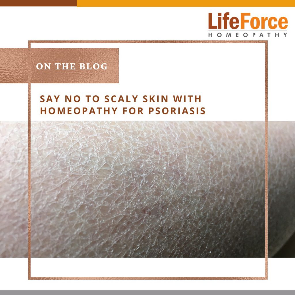 Say No to Scaly Skin With Homeopathy For Psoriasis