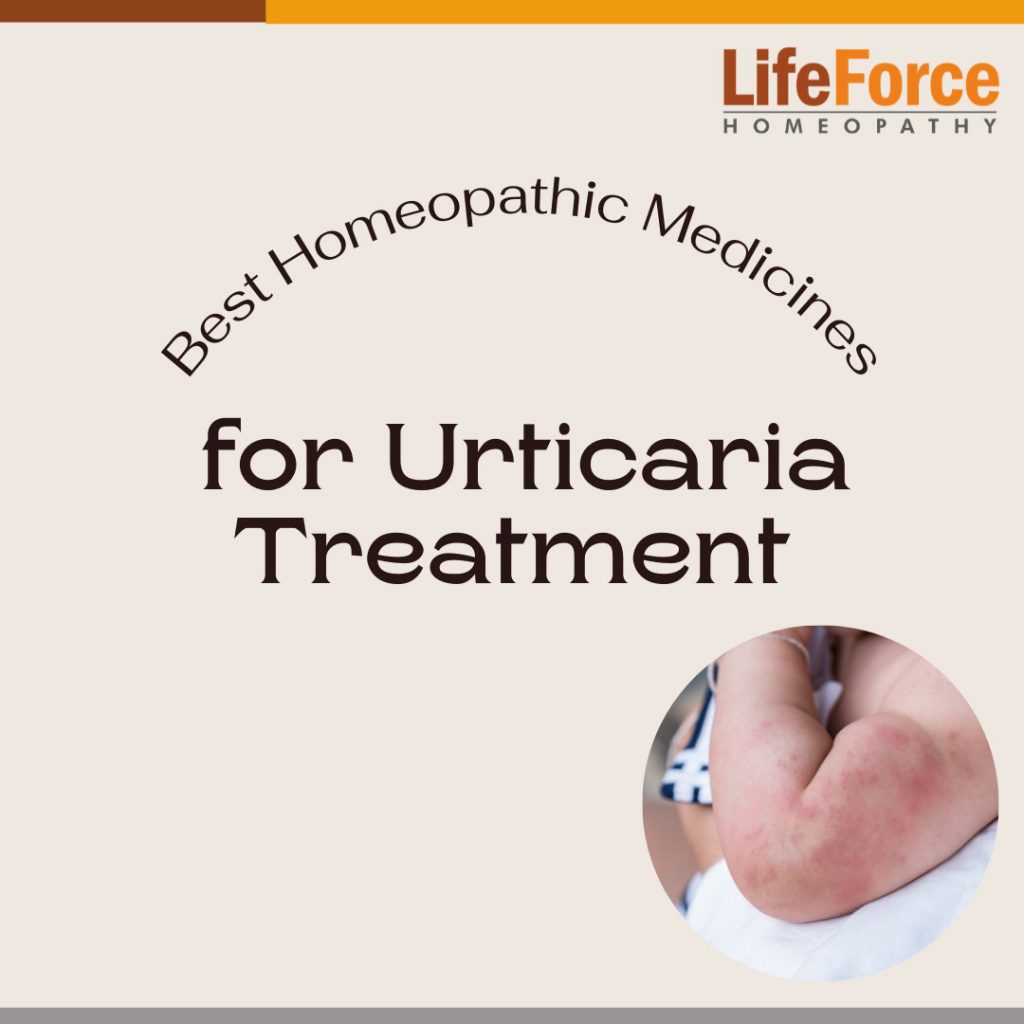 best homeopathic medicine for urticaria treatment