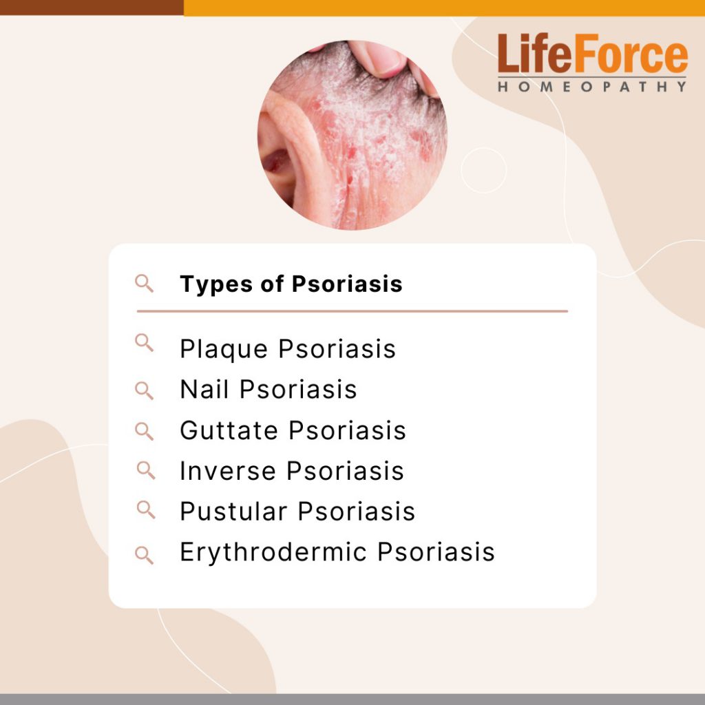 guttate psoriasis treatment in homeopathy