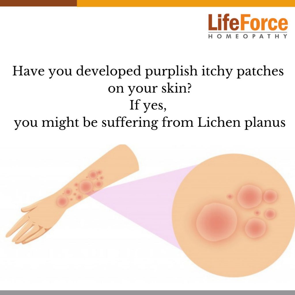 Lichen Planus: Types, Causes, Symptoms, And Homeopathic Treatment