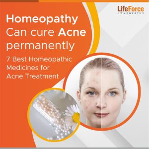 7 Best Homeopathic Medicines For Acne Treatment