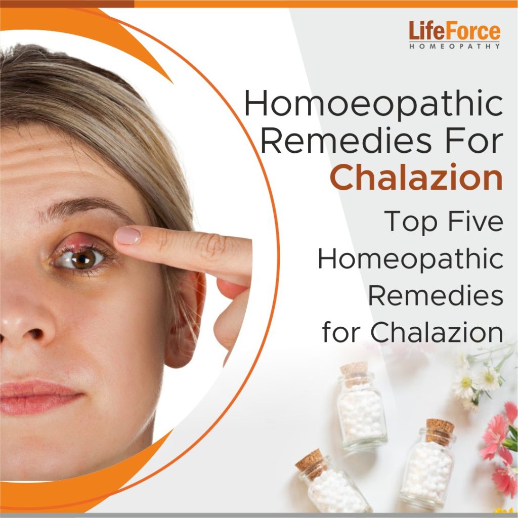 Top Five Homoeopathic Remedies For Chalazion