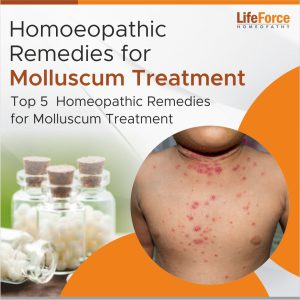 Homoeopathic Remedies for Molluscum Treatment
