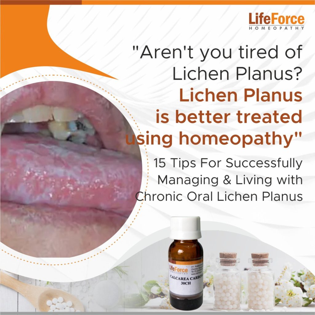 15 Tips For Successfully Managing & Living with Chronic Oral Lichen Planus