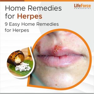 9 Easy Home Remedies for Herpes