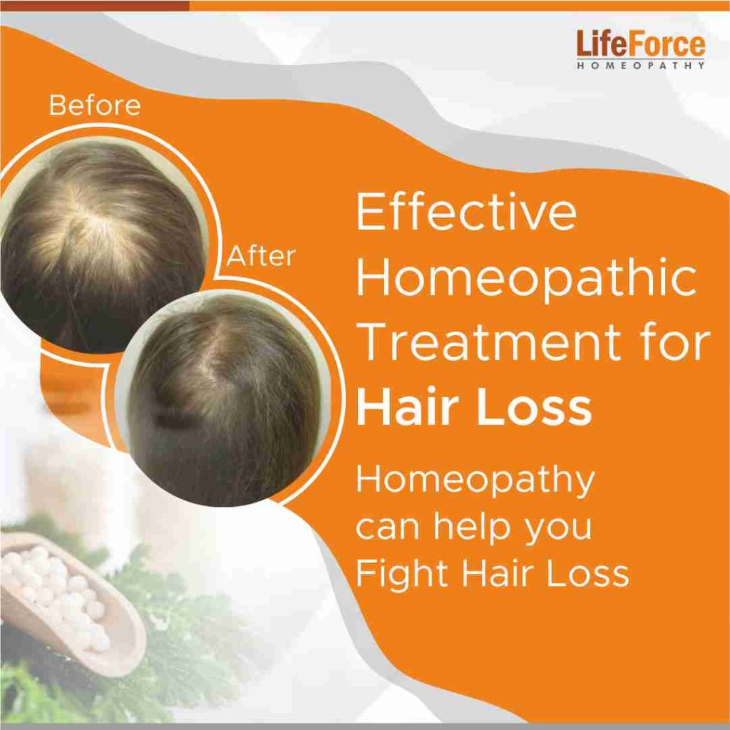 Effective Homeopathic Treatment for Hair Loss: Overview & Details