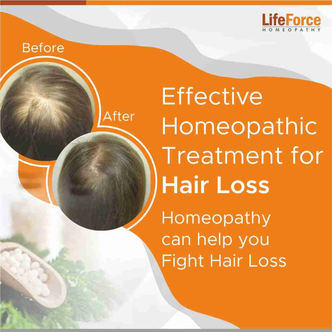 10 Best Homeopathy Medicine for Hair Fall and Regrowth