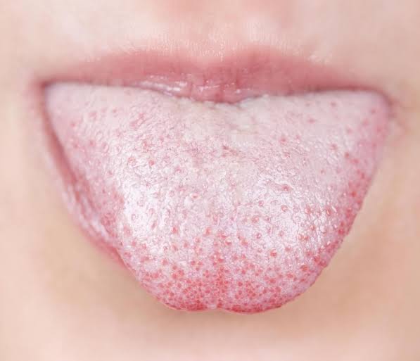 10 Natural Treatments For White Tongue