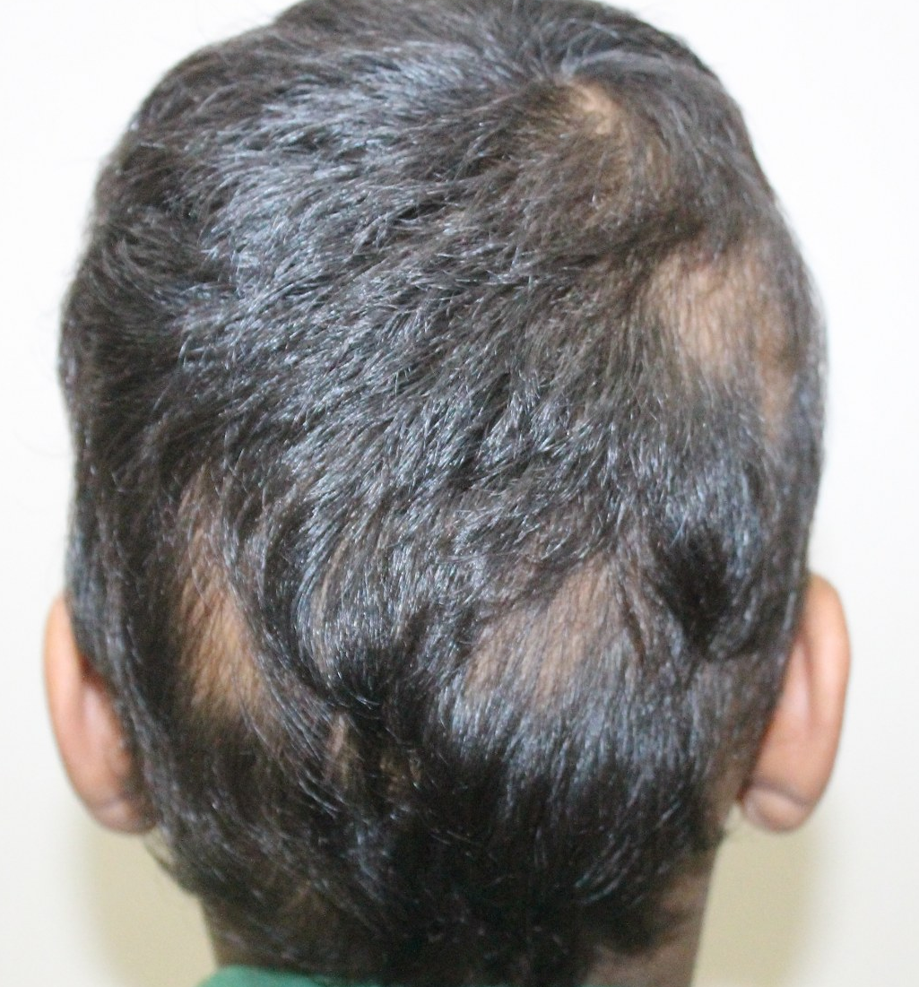 Astonishing results in extensive Alopecia Areata at Life Force