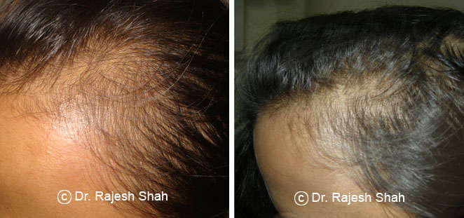 Hair Loss Before and After Treatment Photos Collection