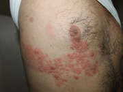 herpes zoster on shoulders