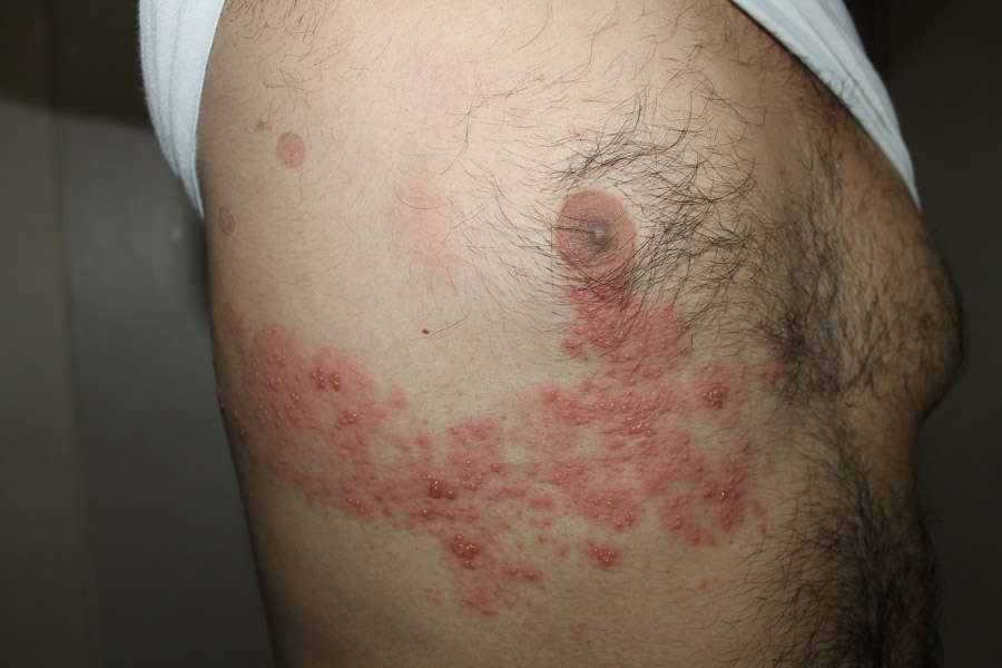 Herpes Zoster Homeopathic Treatment Causes Symptoms Transmission