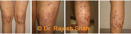 Reactive perforating collagenosis on thighs & legs
