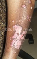 Lichen planus vitiligo
