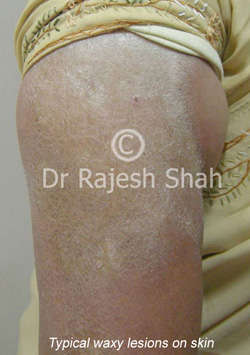 Morphea-on-right-arm