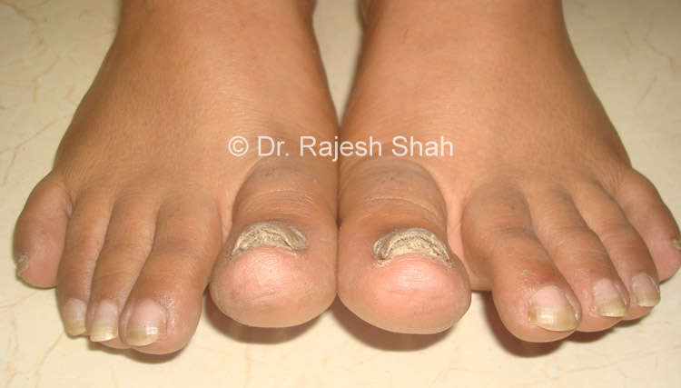 Onychomycosis (Nail Fungus) Homeopathic Treatment |Causes and Risk Factors