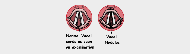 Vocal Cord Nodules Homeopathic Treatment