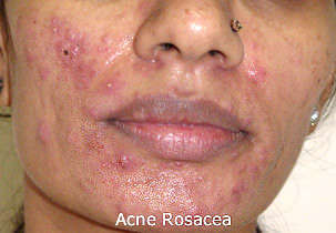 Acne Rosea on cheeks and chin