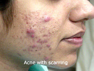 Acne with Scaring on face