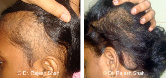 Hair Loss Before and After Treatment Photos Collection