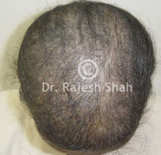 Alopecia areata on complete scalp