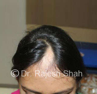 Alopecia areata on scalp