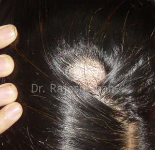Symptoms of Alopecia Areata (Excessive Hair Loss, Bald Spots)