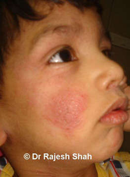 Child with eczema on face