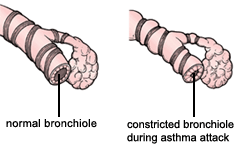 Bronchiole during asthma attack