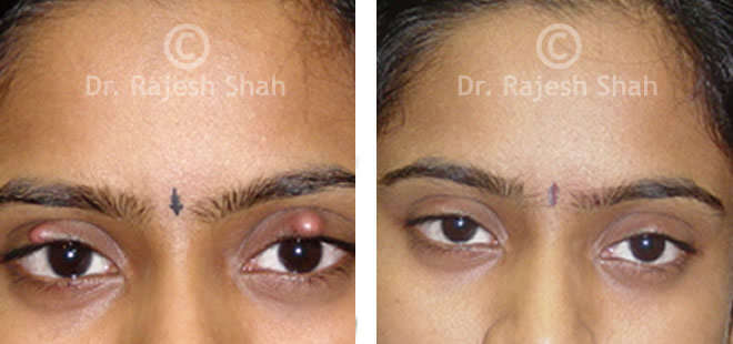 Chalazion before and after treatment photos