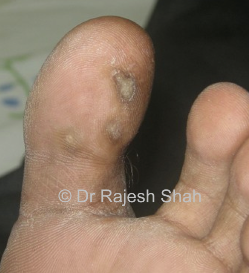 Homeopathy Treatment for Corns (Callosoties) on great toe