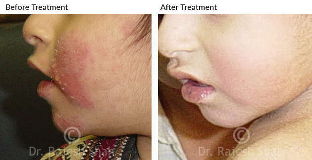 Eczema on Face Before & After Treatment Photo