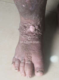 Symptoms of Elephantiasis on Foot & Homeopathic Treatment