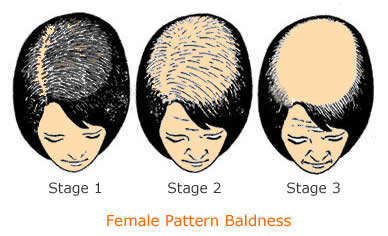 Female Pattern Baldness Stages