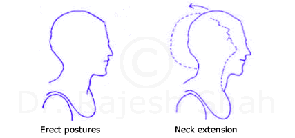 Flexiblity exercise neck extension for cervical spondylosis