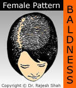 Female pattern baldness