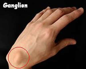 Causes & Homeopathic Treatment for Ganglion