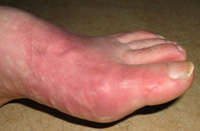 gout on toes
