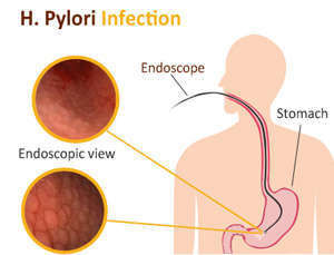 H-Pylori infection