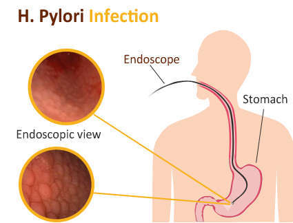 H-Pylori: Homeopathy Treatment, Causes, Symtoms & Diagnosis