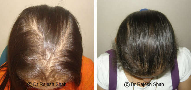Effective diagnostics of the causes of excessive hair loss and balding EHA   elemental hair analysis  Lifelinediag