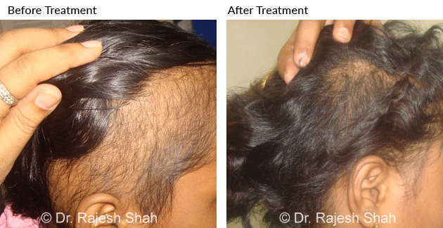 Patient Treated for Hair Loss with Homeopathy by Doctor Shah