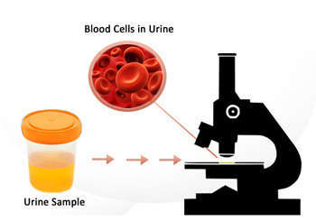 Hematuria Blood in Urine