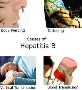 Causes of Hepatitis B