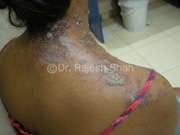 herpes zoster on neck and shoulders