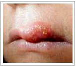 Herpes under the lips